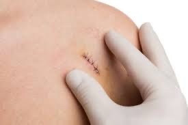 Laceration repair - arms, legs, back, abdomen, chest