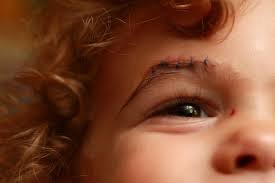 Laceration repair - face, scalp, or neck